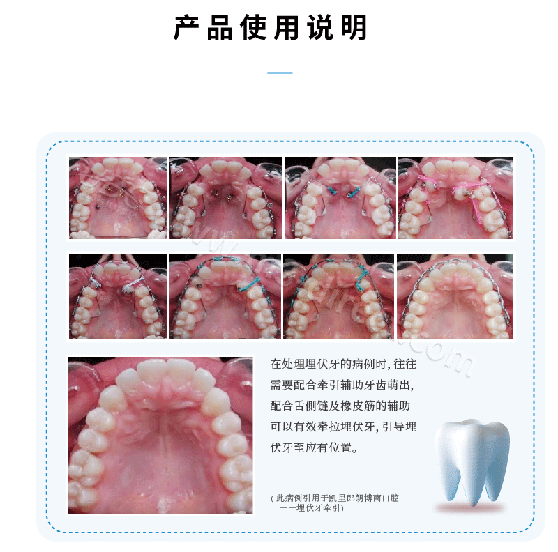 【仅展示】舌侧扣链